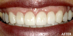 full mouth rehab 2